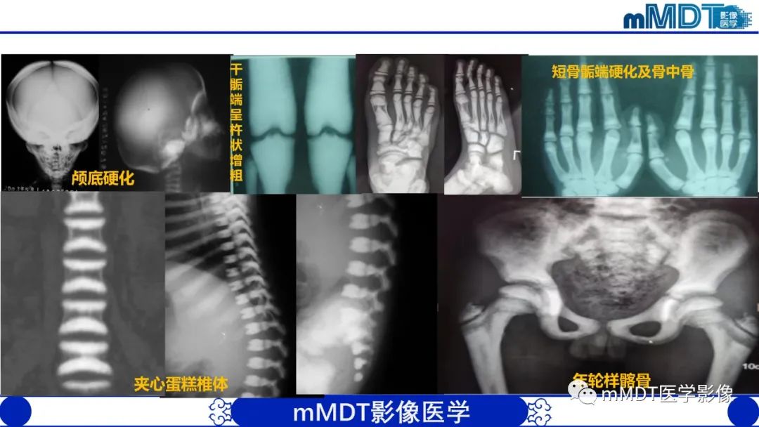 影像PPT - 【PPT】弥漫性骨密度增高影像学浅析-8