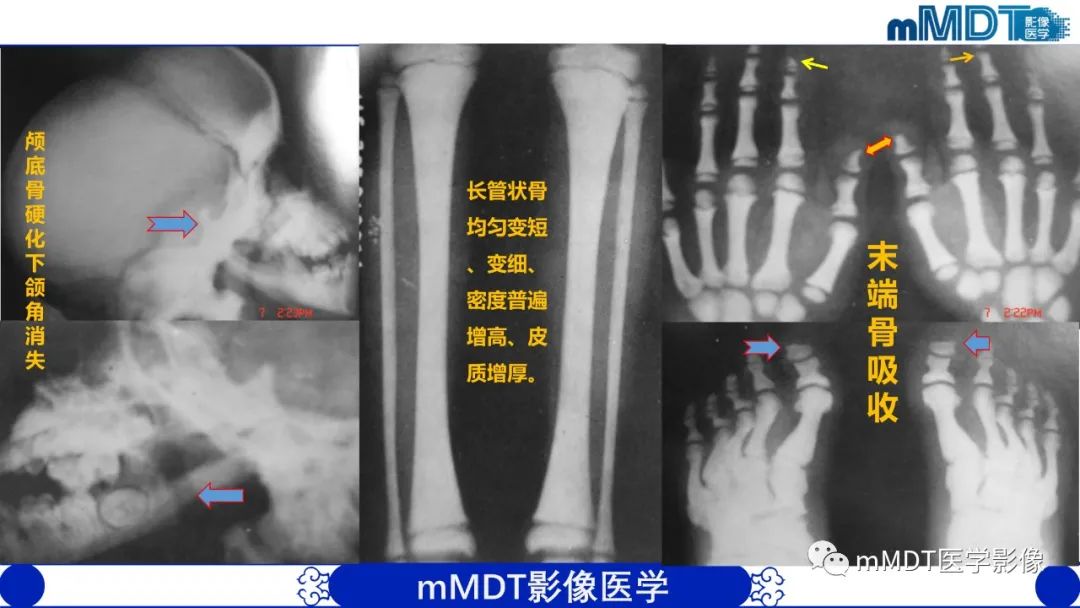 影像PPT - 【PPT】弥漫性骨密度增高影像学浅析-11