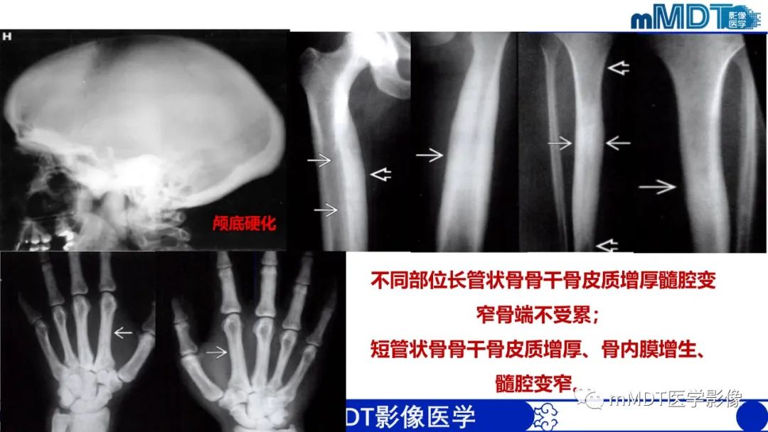 影像PPT - 【PPT】弥漫性骨密度增高影像学浅析-14