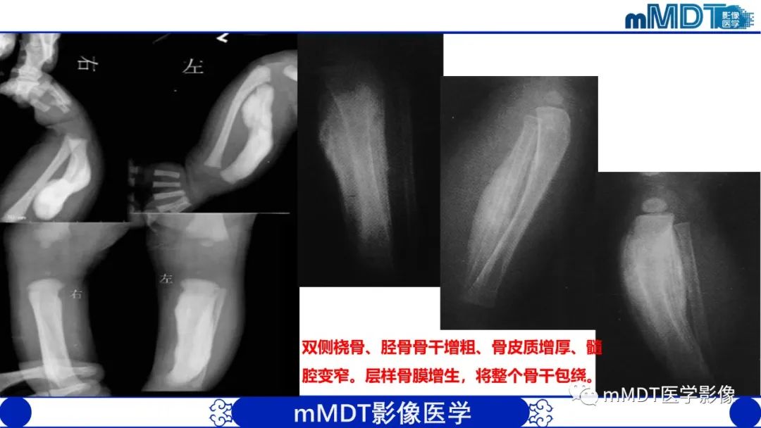 影像PPT - 【PPT】弥漫性骨密度增高影像学浅析-17