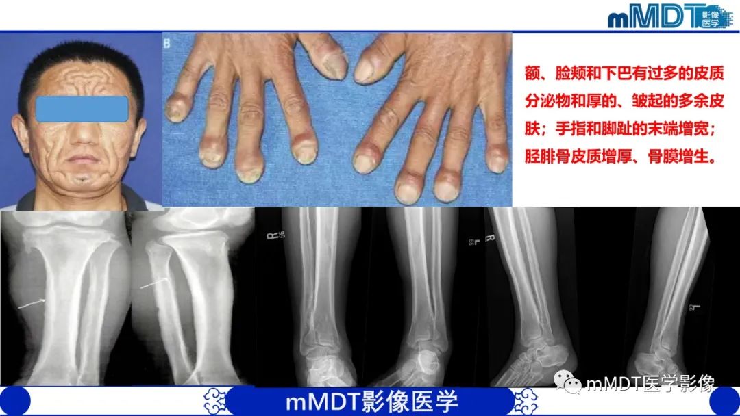 影像PPT - 【PPT】弥漫性骨密度增高影像学浅析-20