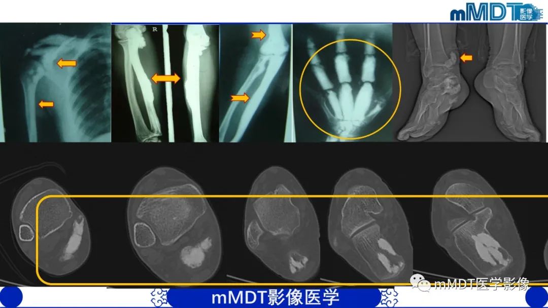 影像PPT - 【PPT】弥漫性骨密度增高影像学浅析-23