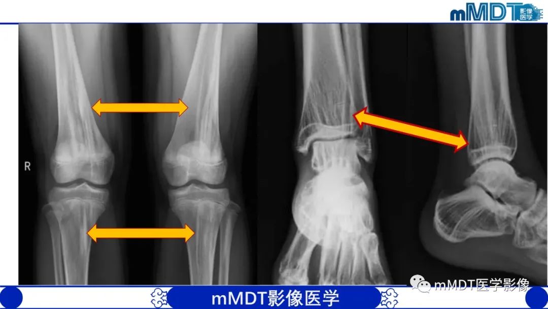 影像PPT - 【PPT】弥漫性骨密度增高影像学浅析-29