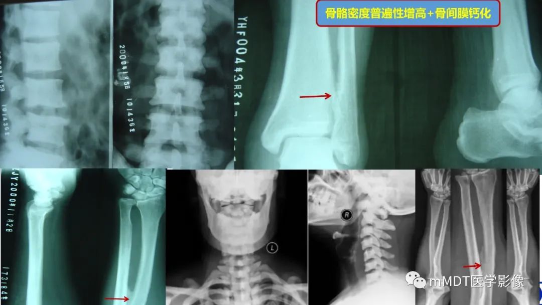 影像PPT - 【PPT】弥漫性骨密度增高影像学浅析-33