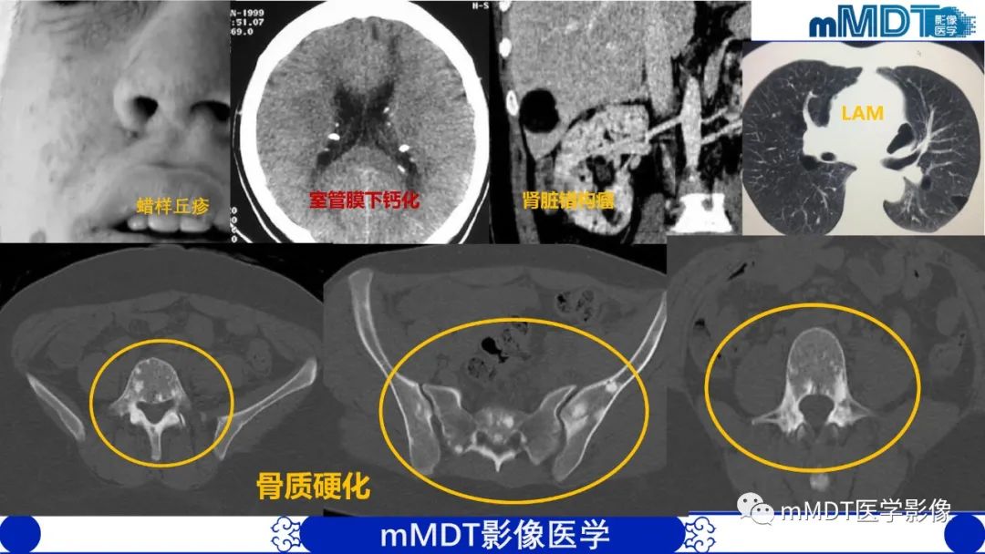 影像PPT - 【PPT】弥漫性骨密度增高影像学浅析-39