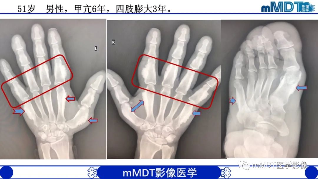 影像PPT - 【PPT】弥漫性骨密度增高影像学浅析-45