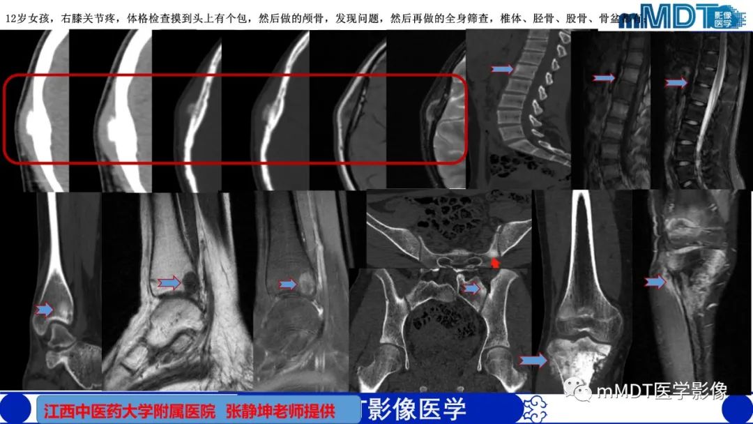 影像PPT - 【PPT】弥漫性骨密度增高影像学浅析-49