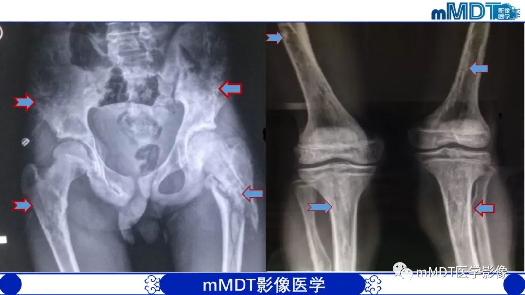影像PPT - 【PPT】弥漫性骨密度增高影像学浅析-52