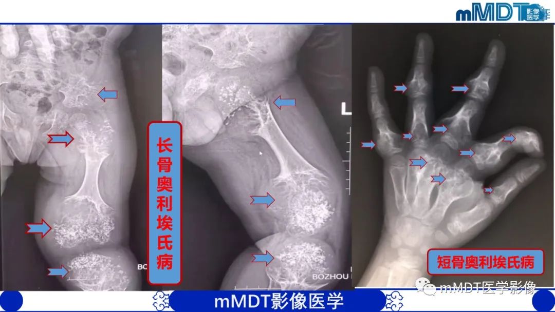 影像PPT - 【PPT】弥漫性骨密度增高影像学浅析-53