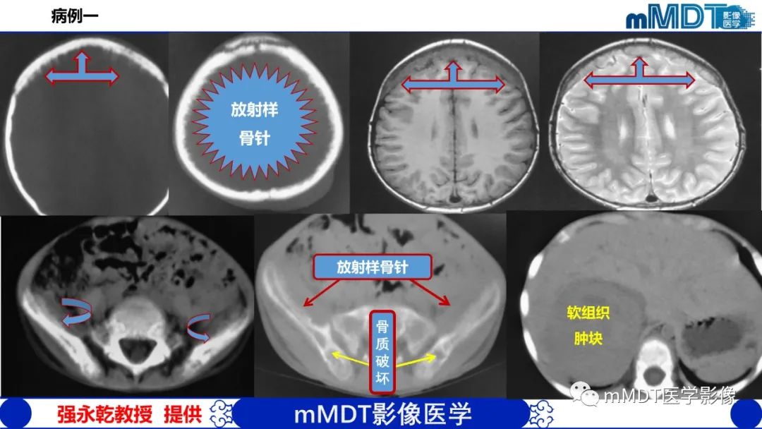 影像PPT - 【PPT】弥漫性骨密度增高影像学浅析-59