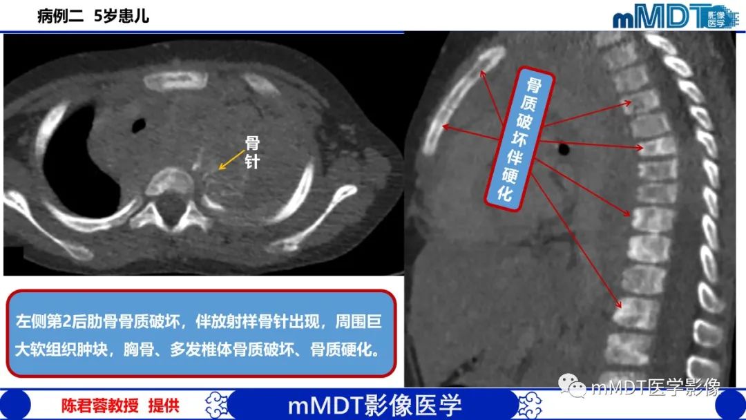 影像PPT - 【PPT】弥漫性骨密度增高影像学浅析-60