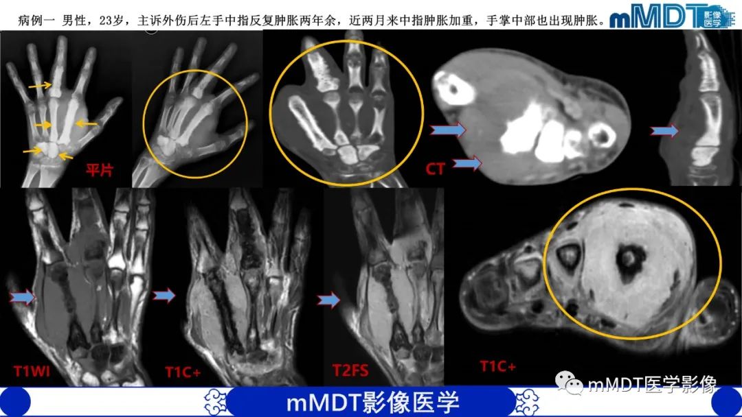 影像PPT - 【PPT】弥漫性骨密度增高影像学浅析-64