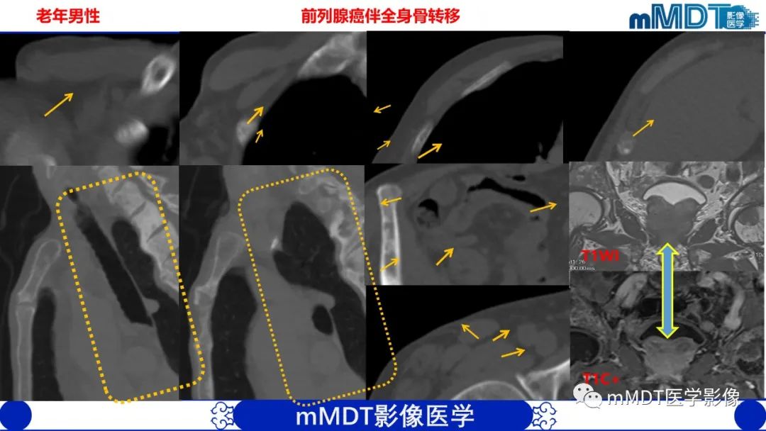 影像PPT - 【PPT】弥漫性骨密度增高影像学浅析-67