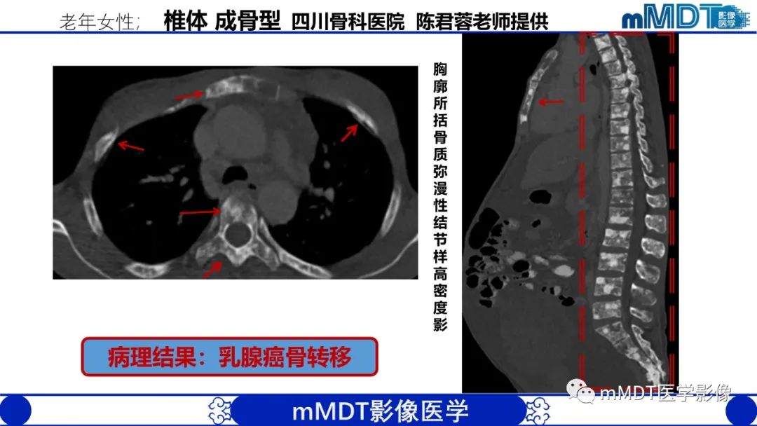 影像PPT - 【PPT】弥漫性骨密度增高影像学浅析-68