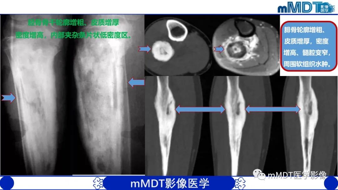 影像PPT - 【PPT】弥漫性骨密度增高影像学浅析-72
