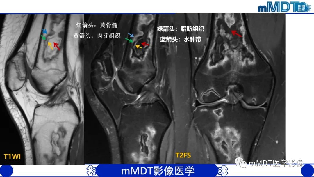 影像PPT - 【PPT】弥漫性骨密度增高影像学浅析-78