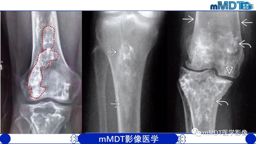 影像PPT - 【PPT】弥漫性骨密度增高影像学浅析-79