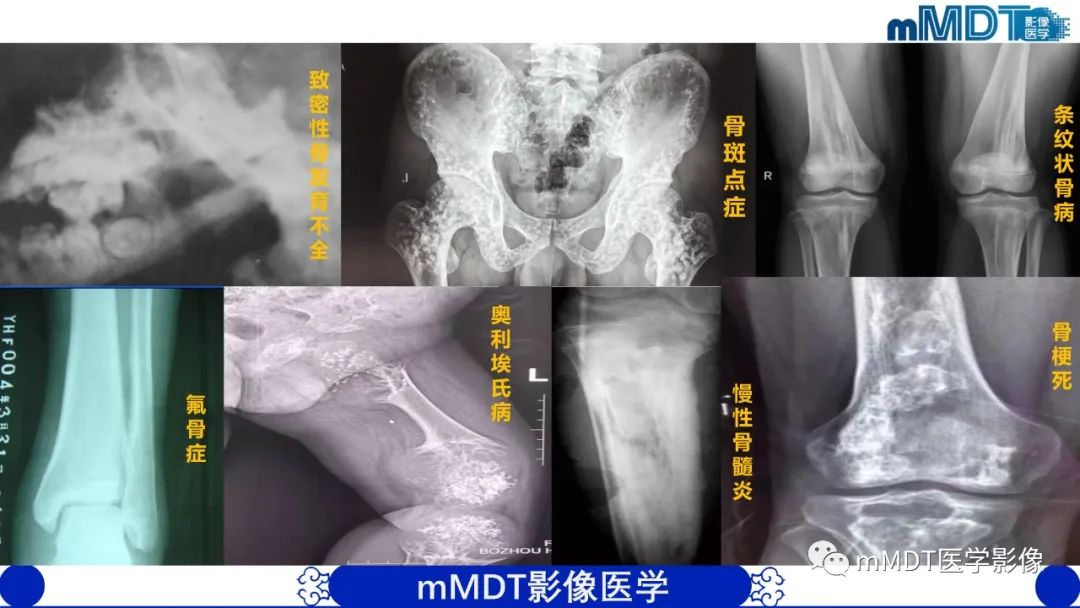 影像PPT - 【PPT】弥漫性骨密度增高影像学浅析-80