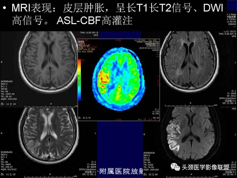 影像PPT - 【PPT】脑皮层病变的MRI表现-4
