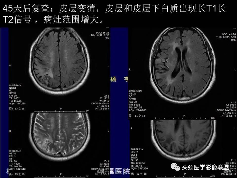 影像PPT - 【PPT】脑皮层病变的MRI表现-6
