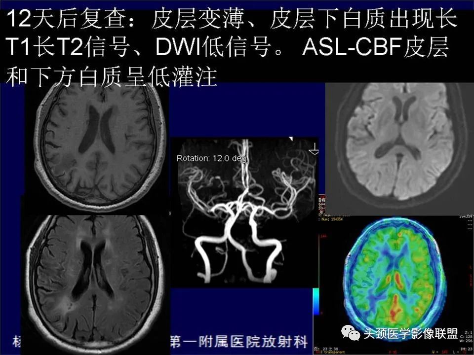影像PPT - 【PPT】脑皮层病变的MRI表现-5