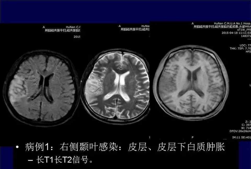 影像PPT - 【PPT】脑皮层病变的MRI表现-11