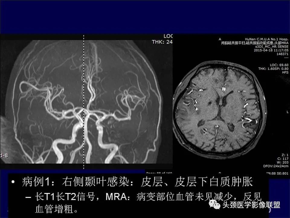 影像PPT - 【PPT】脑皮层病变的MRI表现-12