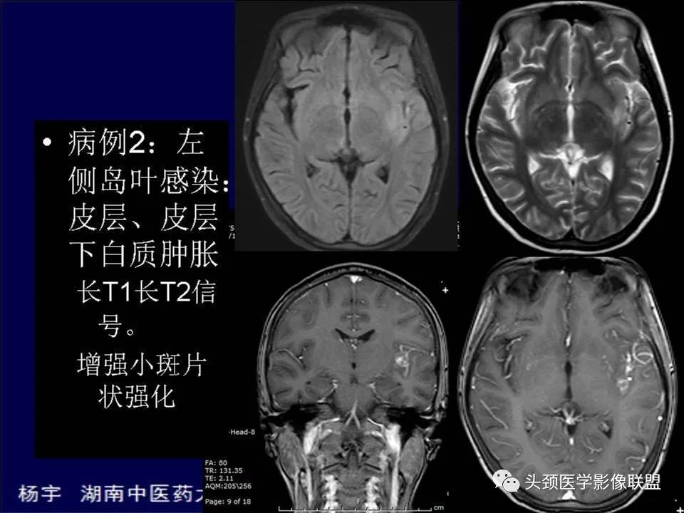 影像PPT - 【PPT】脑皮层病变的MRI表现-13