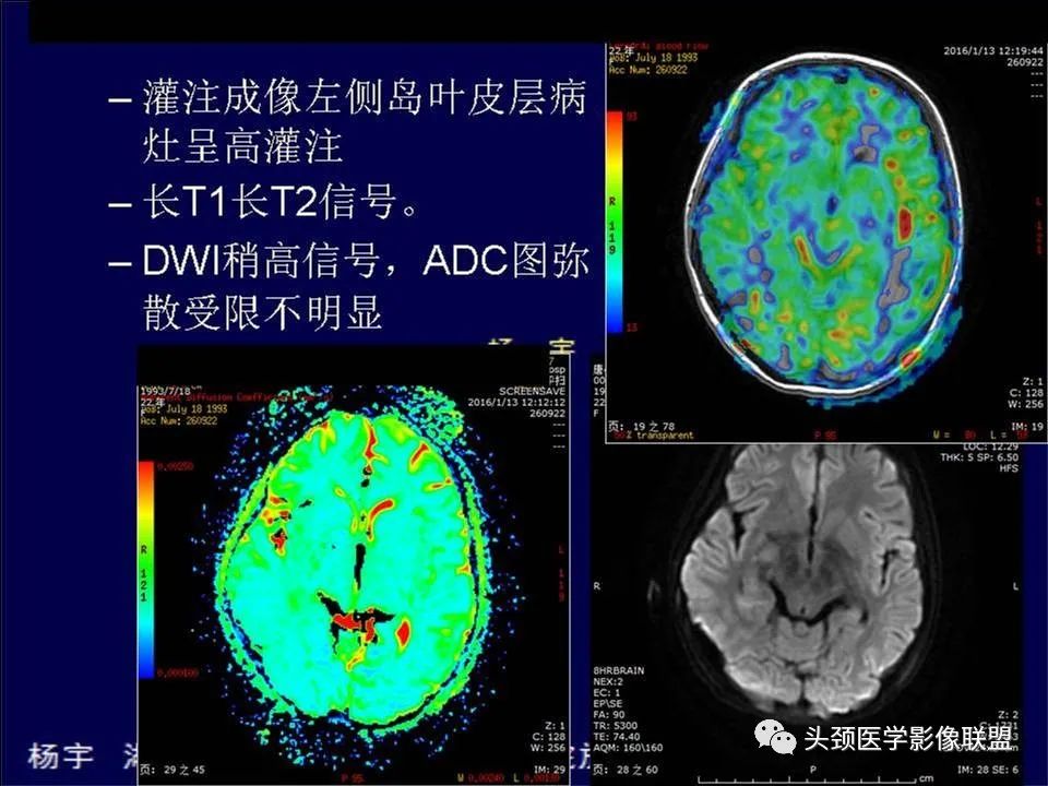 影像PPT - 【PPT】脑皮层病变的MRI表现-14