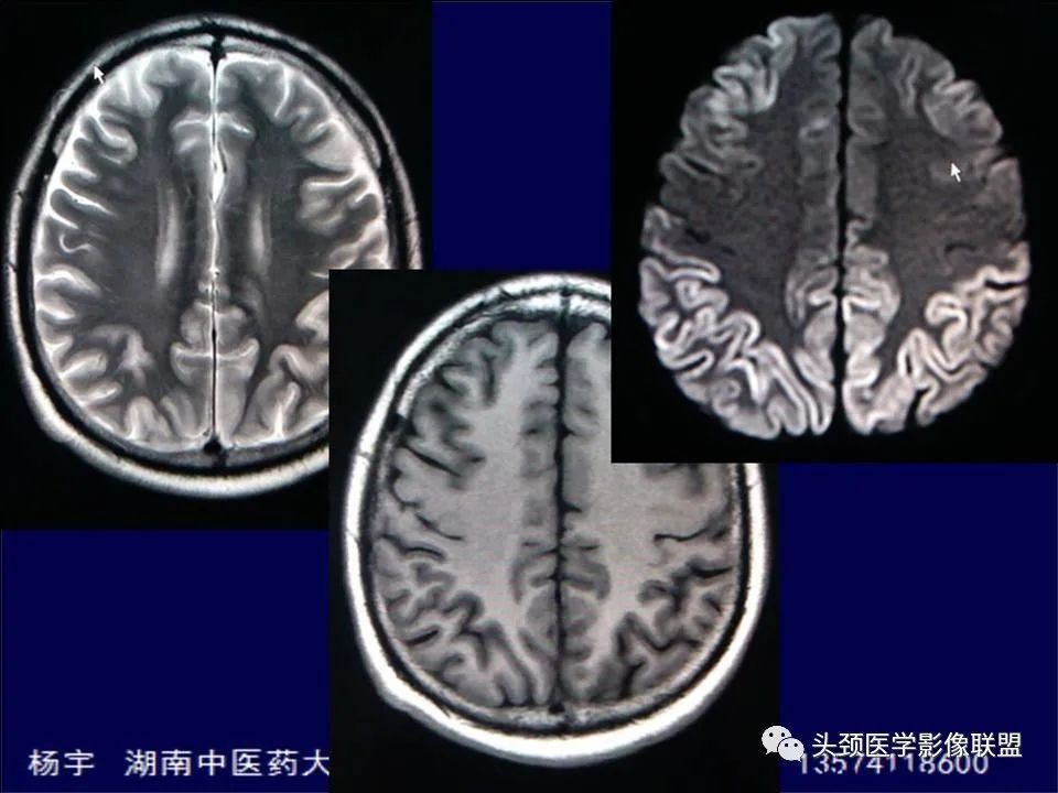 影像PPT - 【PPT】脑皮层病变的MRI表现-24