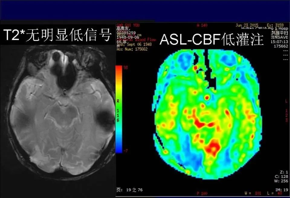 影像PPT - 【PPT】脑皮层病变的MRI表现-29