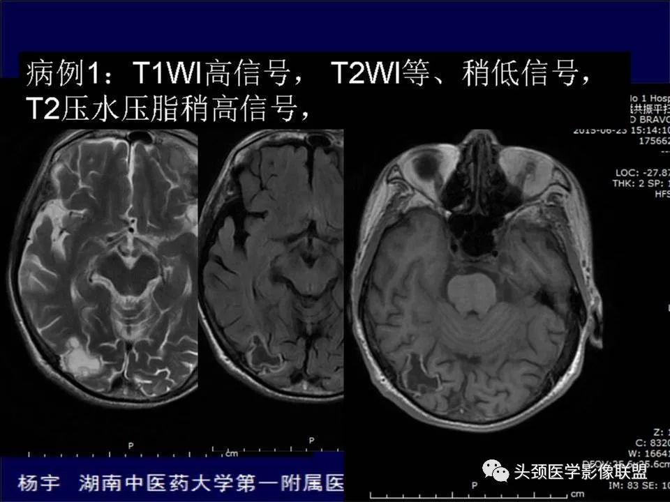 影像PPT - 【PPT】脑皮层病变的MRI表现-27