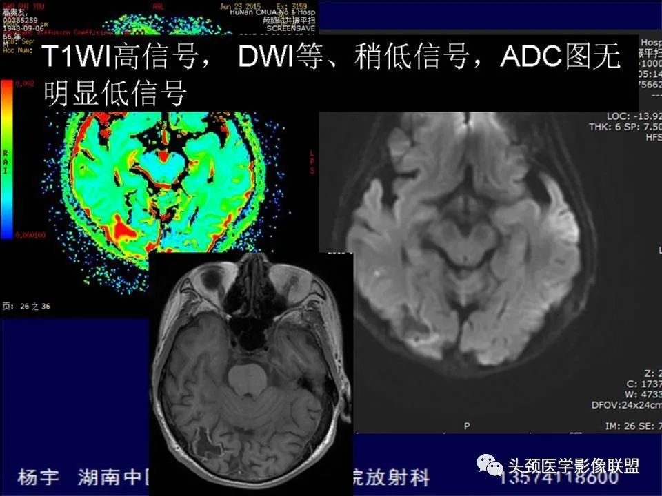 影像PPT - 【PPT】脑皮层病变的MRI表现-28