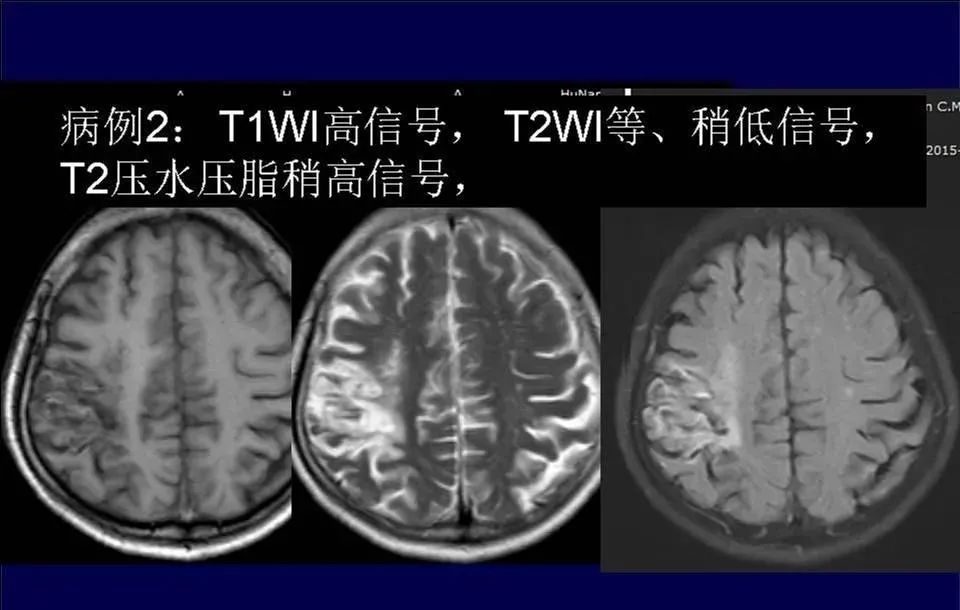 影像PPT - 【PPT】脑皮层病变的MRI表现-30