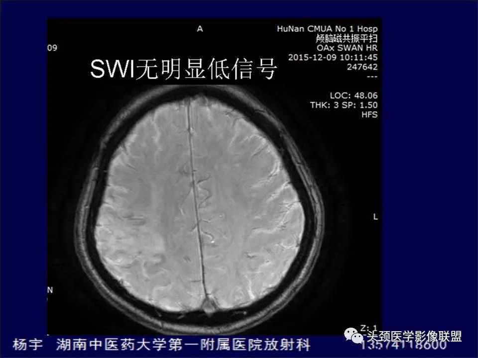 影像PPT - 【PPT】脑皮层病变的MRI表现-31