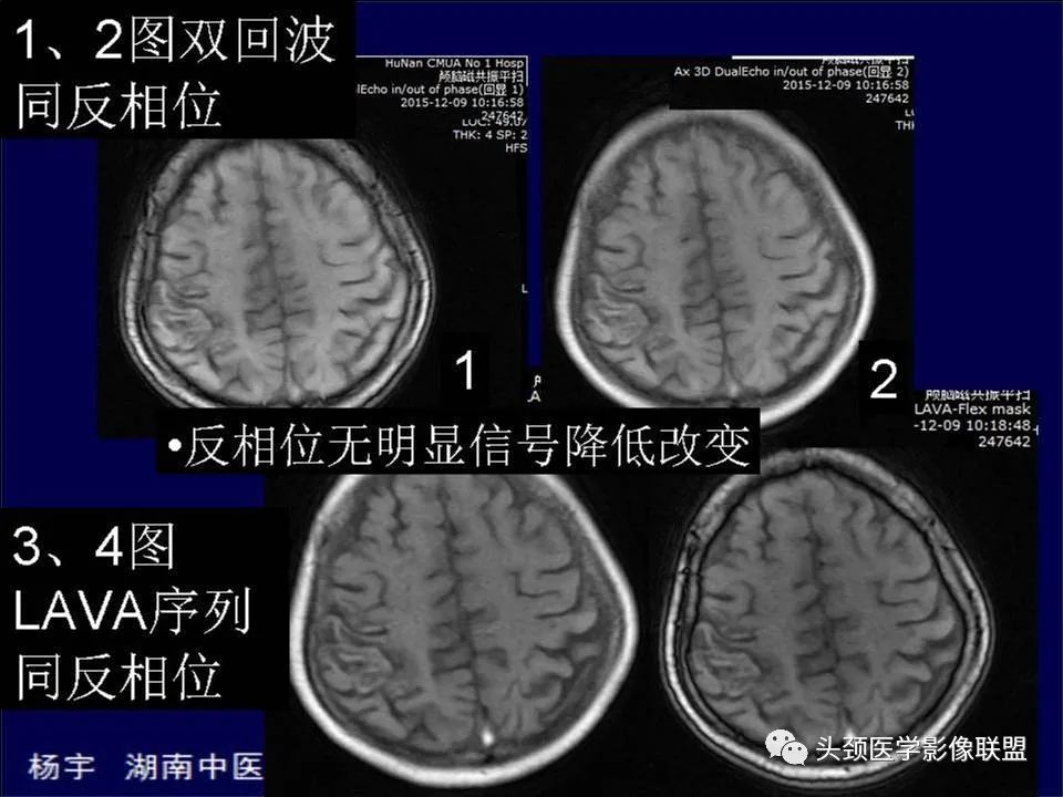 影像PPT - 【PPT】脑皮层病变的MRI表现-32