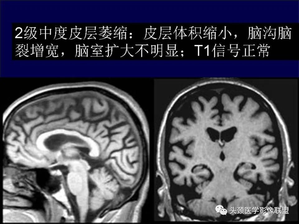 影像PPT - 【PPT】脑皮层病变的MRI表现-36