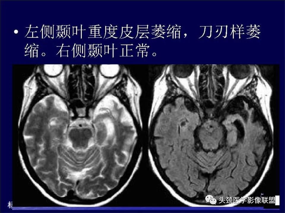 影像PPT - 【PPT】脑皮层病变的MRI表现-37