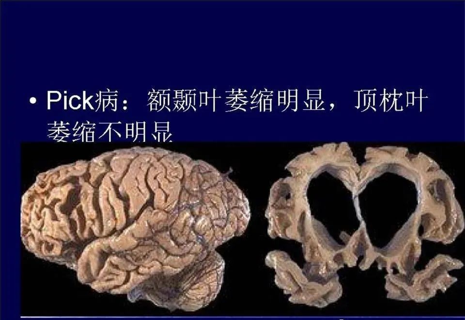 影像PPT - 【PPT】脑皮层病变的MRI表现-39