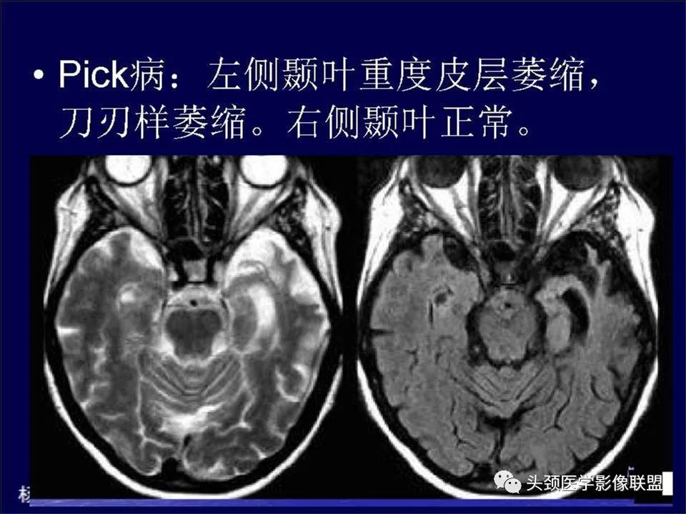 影像PPT - 【PPT】脑皮层病变的MRI表现-40