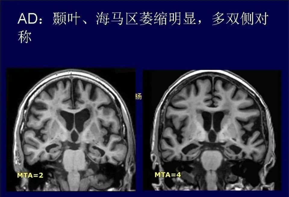 影像PPT - 【PPT】脑皮层病变的MRI表现-41