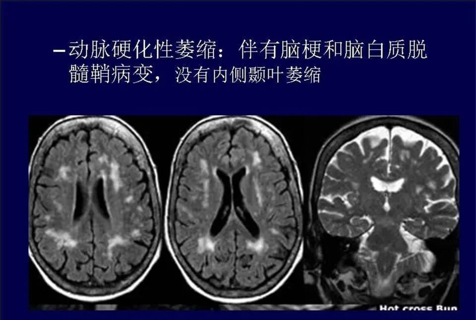 影像PPT - 【PPT】脑皮层病变的MRI表现-42