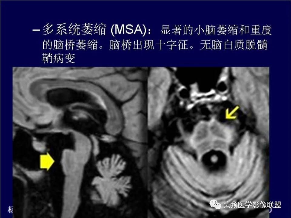 影像PPT - 【PPT】脑皮层病变的MRI表现-43