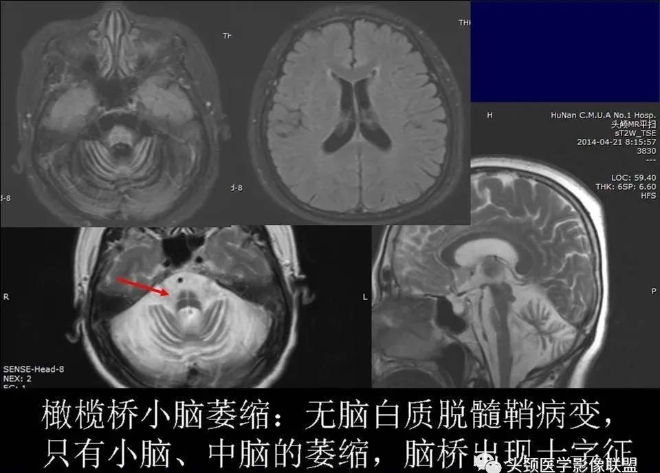 影像PPT - 【PPT】脑皮层病变的MRI表现-44
