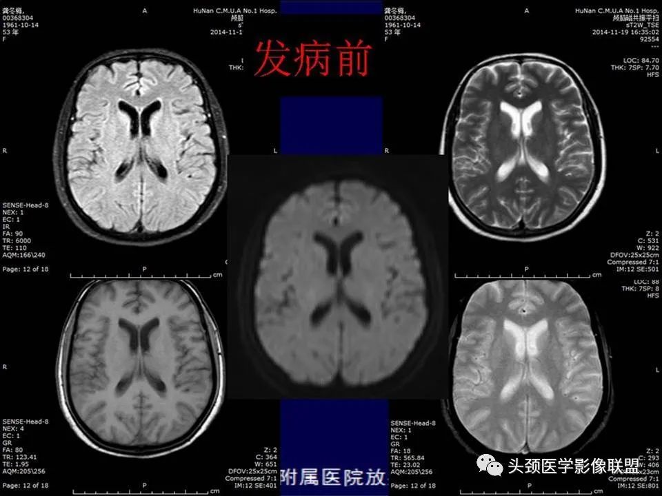 影像PPT - 【PPT】脑皮层病变的MRI表现-48