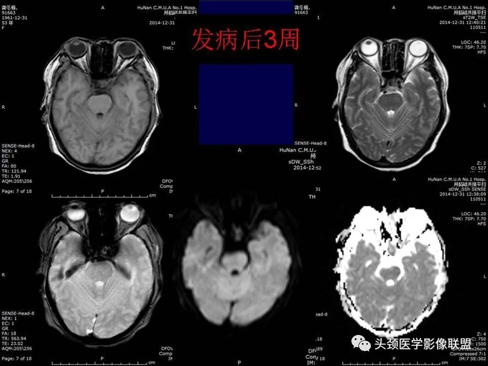 影像PPT - 【PPT】脑皮层病变的MRI表现-50
