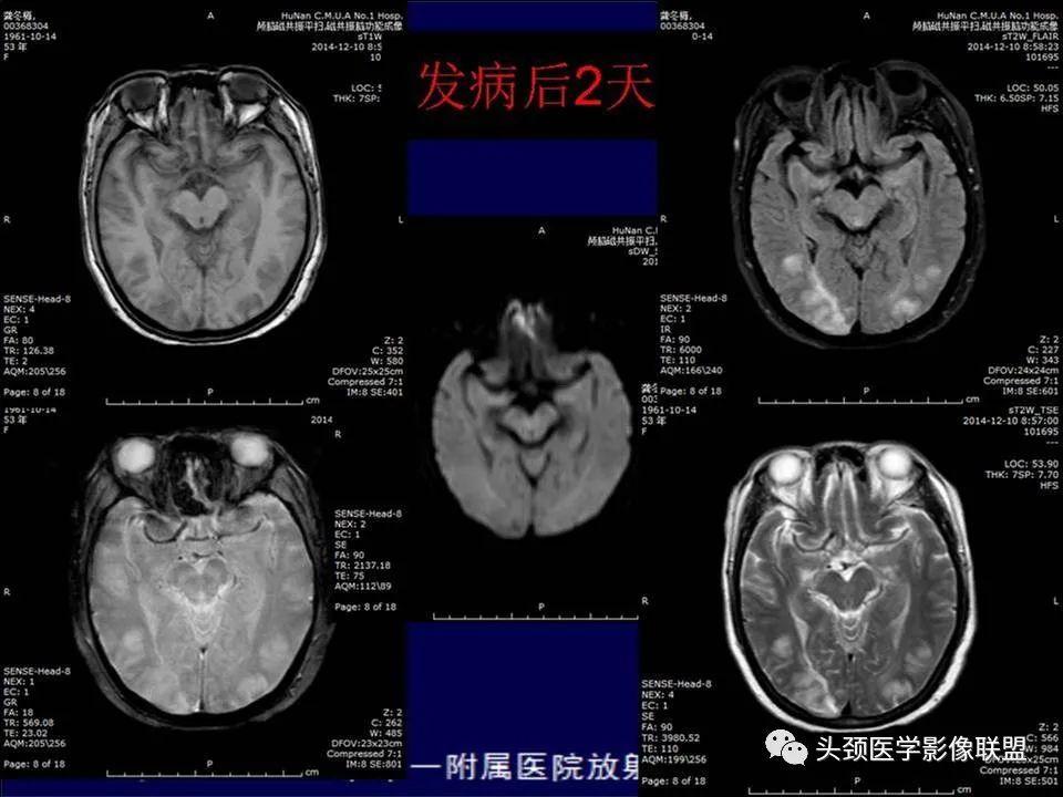 影像PPT - 【PPT】脑皮层病变的MRI表现-49