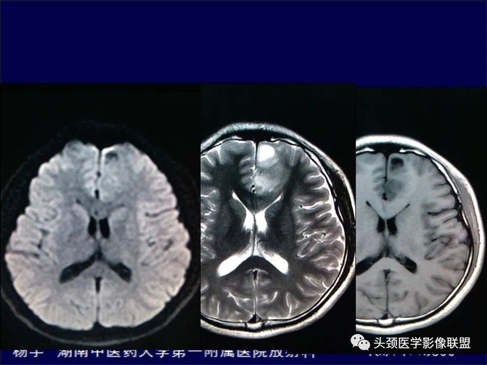 影像PPT - 【PPT】脑皮层病变的MRI表现-52