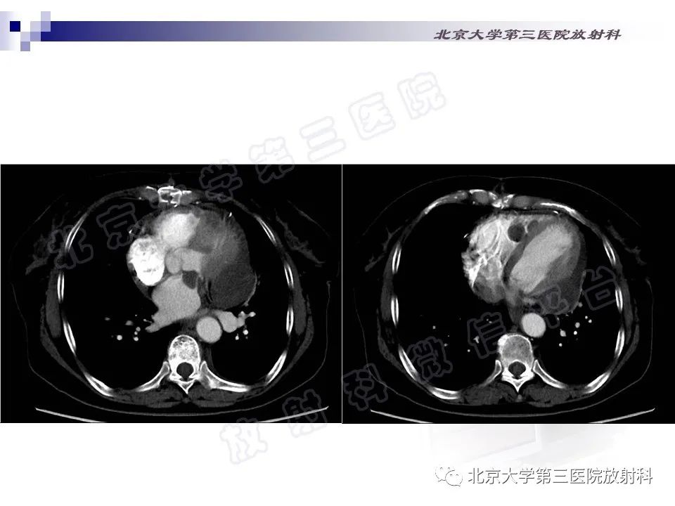 影像PPT - 【PPT】心脏原发性未分化多形性肉瘤-4
