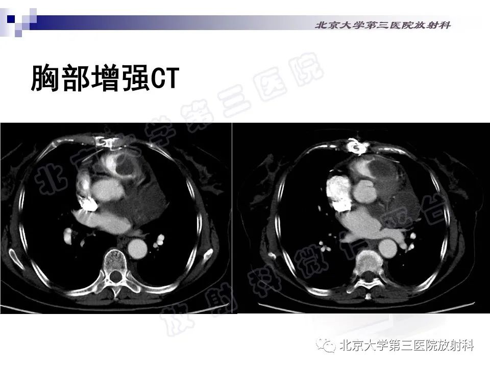 影像PPT - 【PPT】心脏原发性未分化多形性肉瘤-3